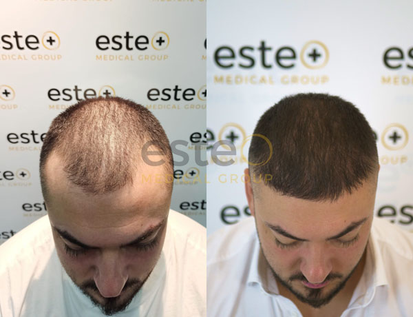 Hair transplant before and after Leeds