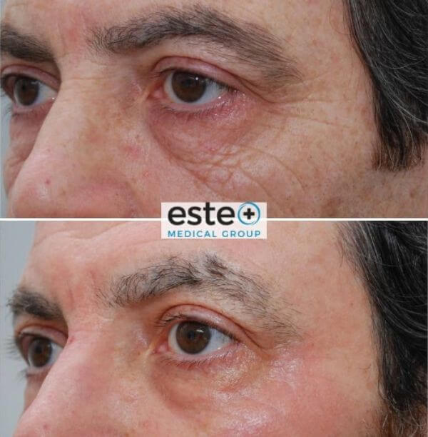 Clearlift Laser Laser Face Lift with Harmony XL Pro Este