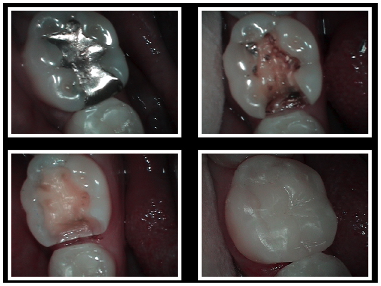 Safe Mercury Dental Filling Removal