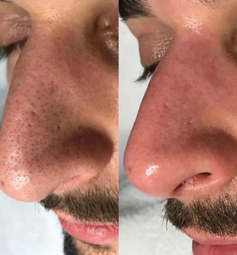 Large Pores Causes & Treatment for Blocked Pores Este Medical Group