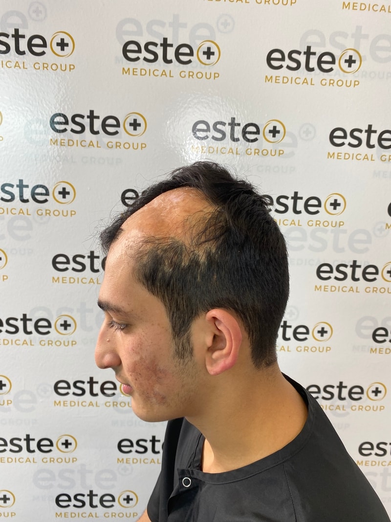 Hair Loss in Women Female Hair Loss Treatment Birmingham