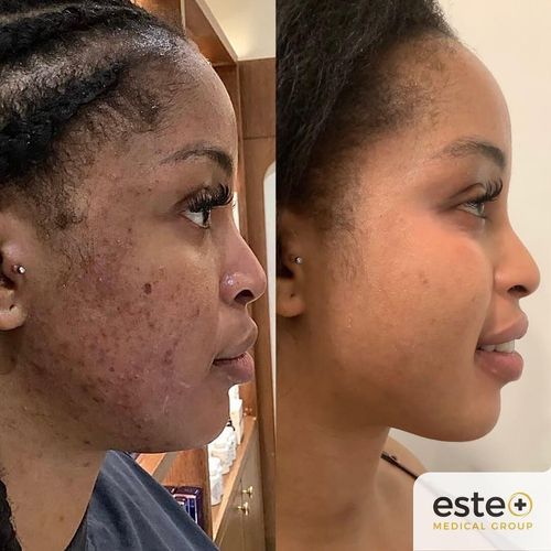 Hyperpigmentation Este Medical Group