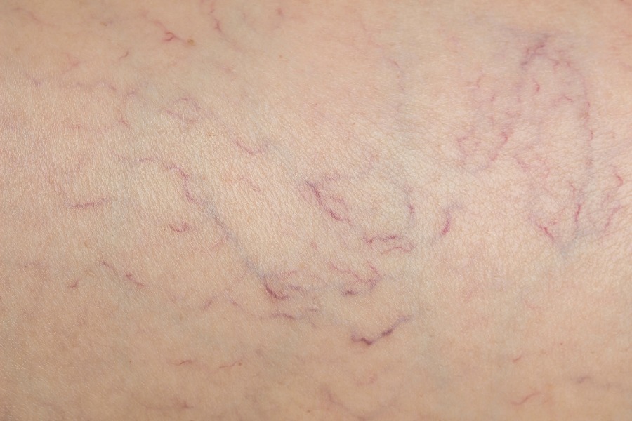 Spider Veins Cause and Treatment Microsclerotherapy Este