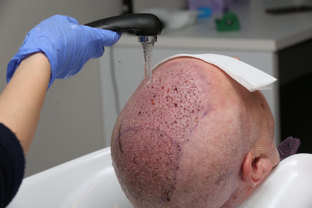 Hair Transplant Aftercare Advice Este