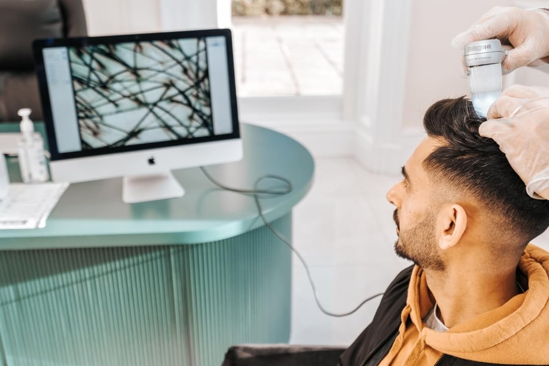 Alopecia Treatment Nottingham | Alopecia Specialists - Este