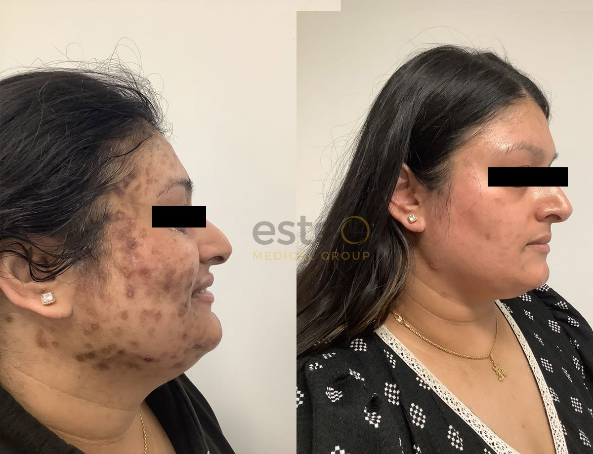 Outstanding Photos After Post Inflammatory Hyperpigmentation Cosmelan 