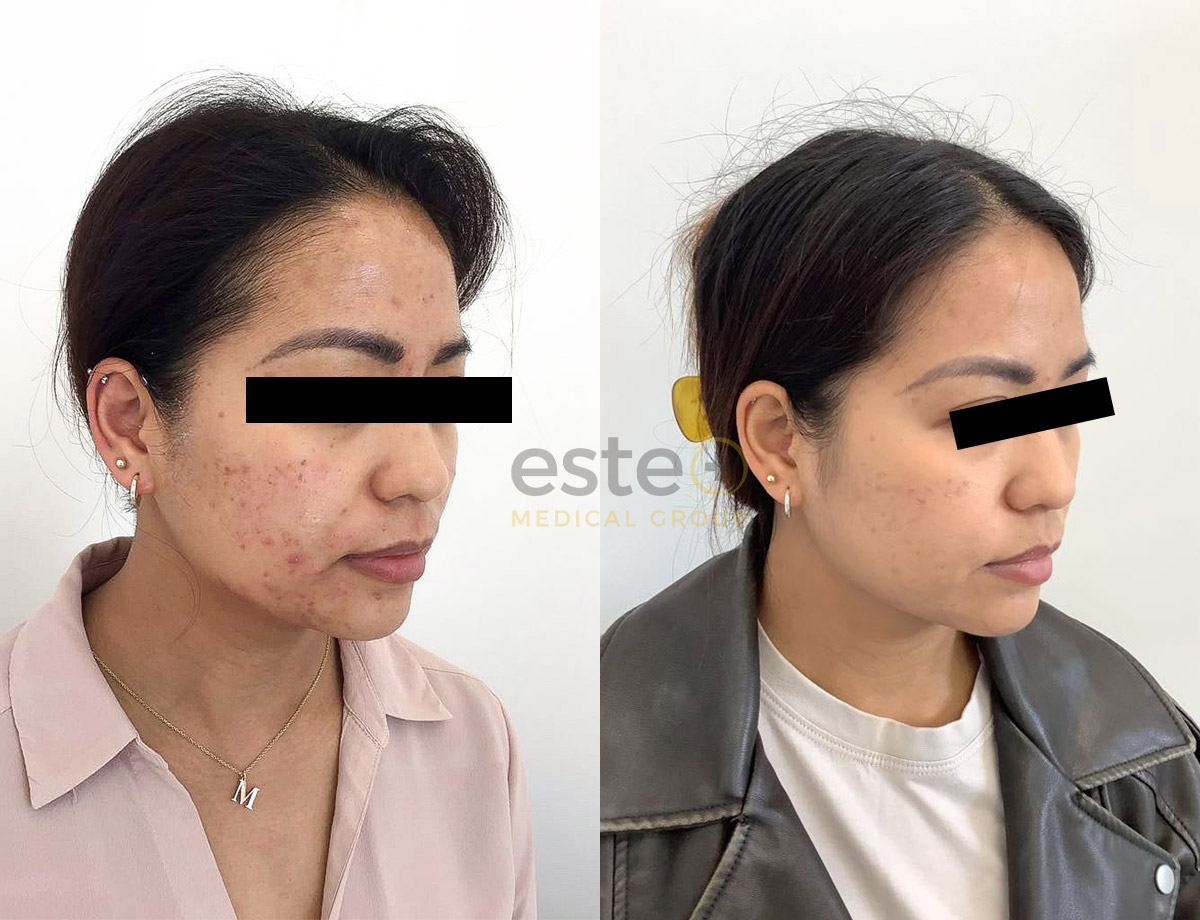 Leeds Woman’s Acne-Prone Skin Transformation After Azelan Peel
