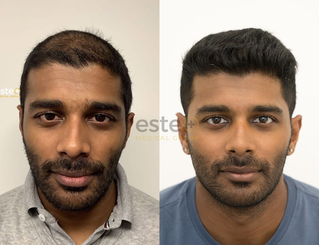 Denzil's Hair Transplant Journey with Este London Este