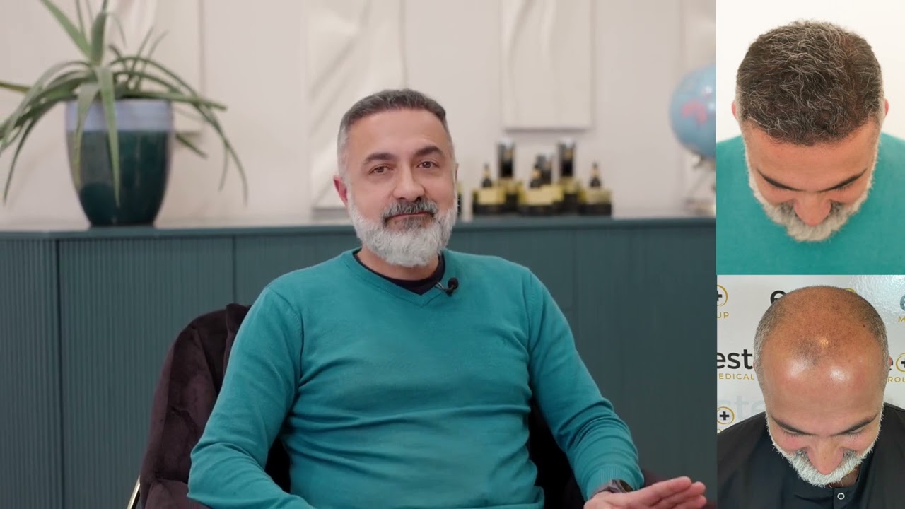 Arash Has Successful Turkey Hair Transplant & Aftercare at Este Leeds