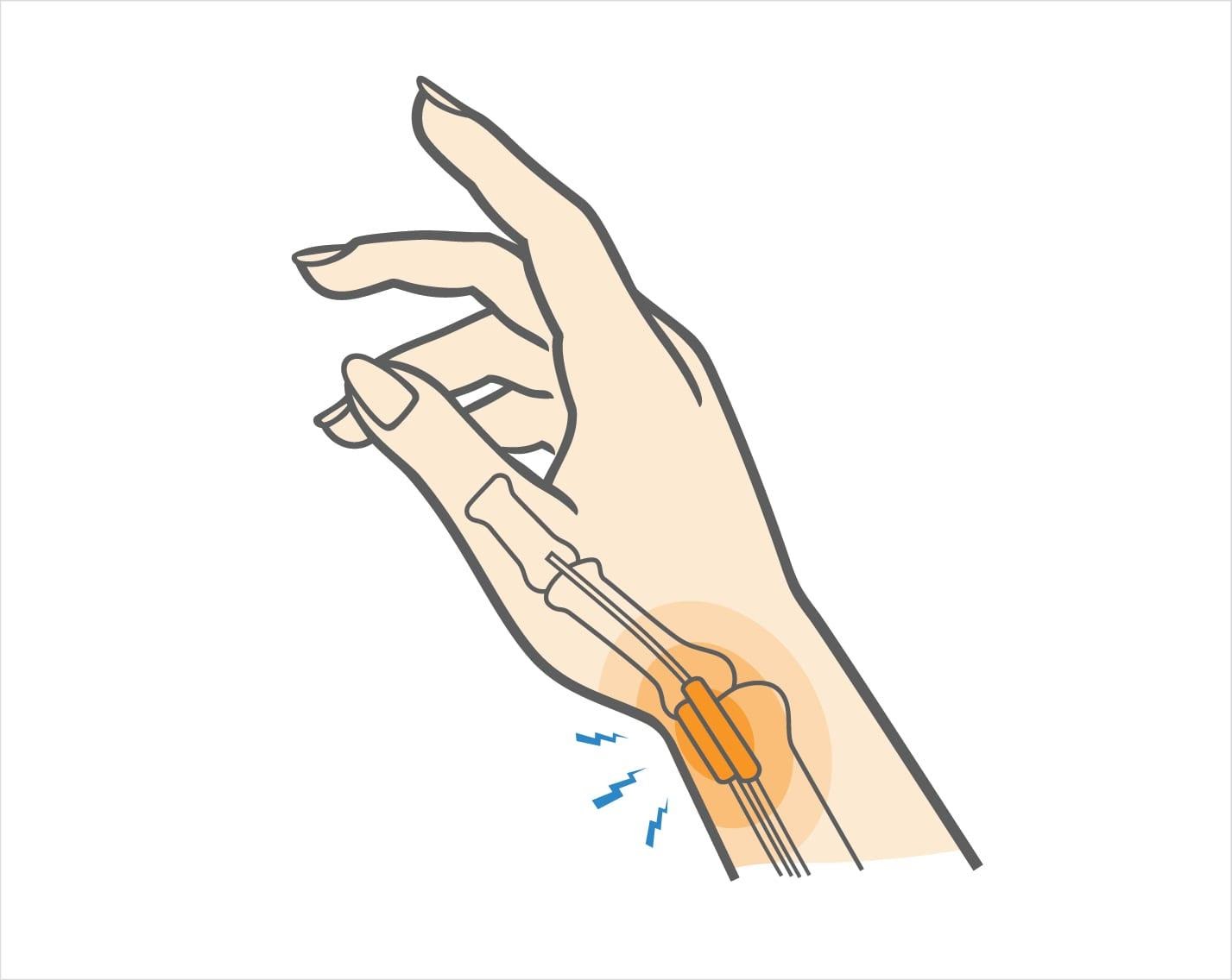 De Quervain Tenosynovitis