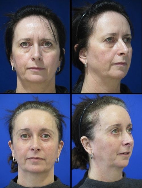 Endoscopic Brow Lift