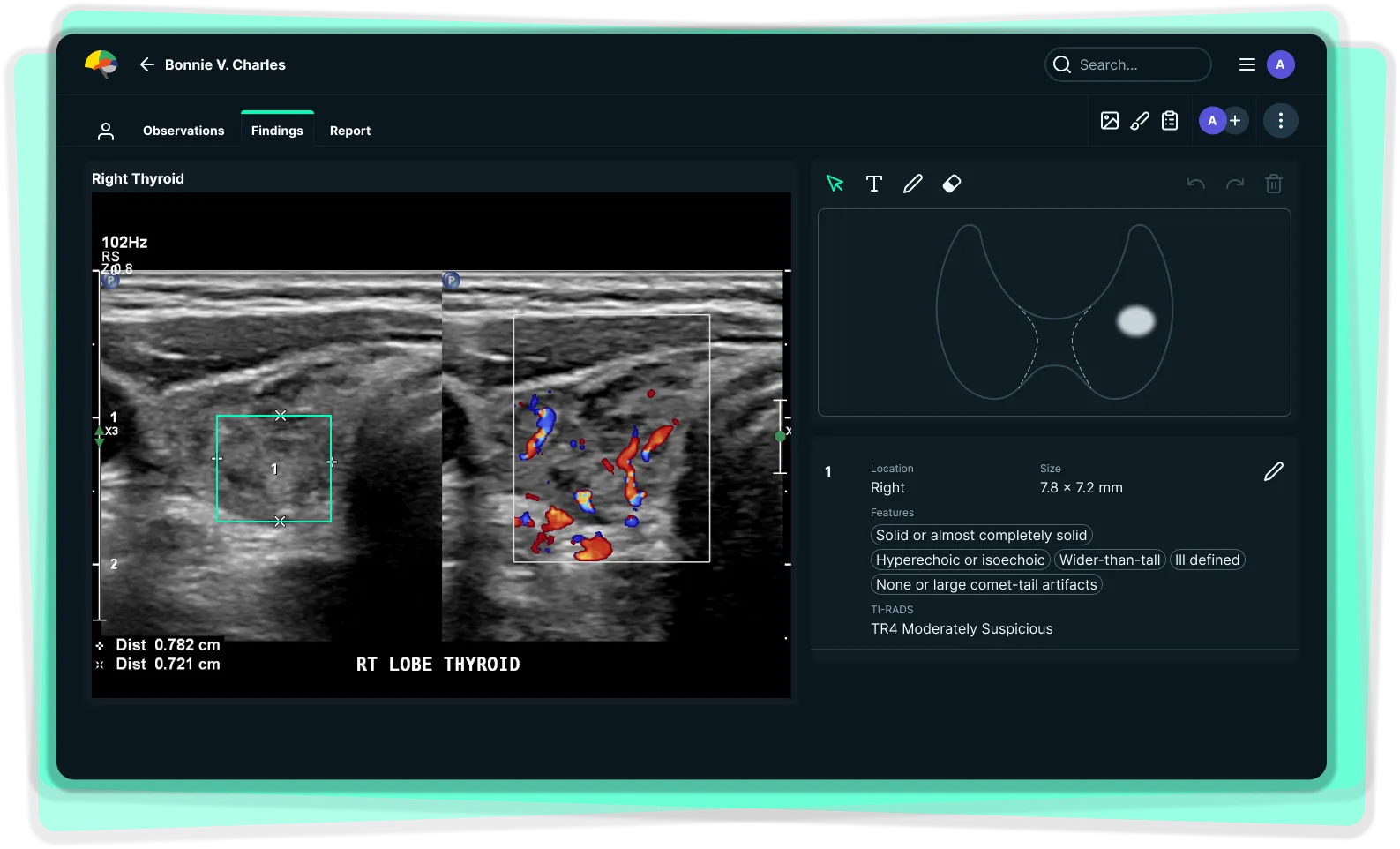 See-Mode Thyroid Study