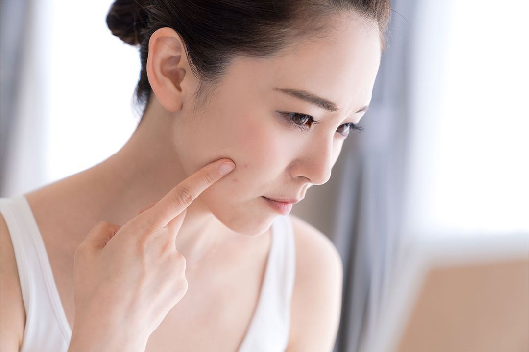 Does Vaping Cause Acne? Here