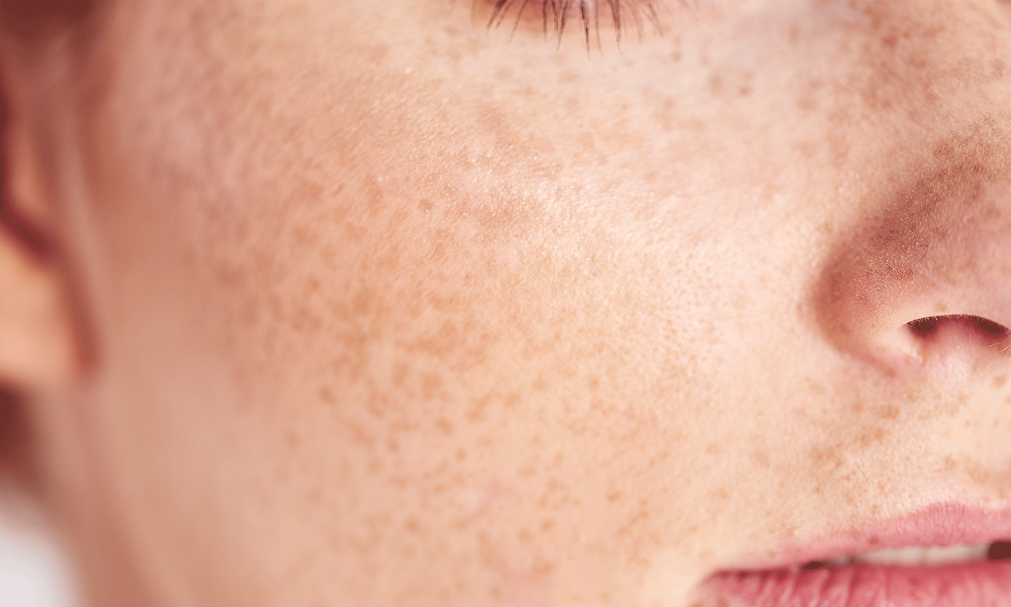 Mole Vs Freckle The Difference Between These Skin Spots Software Mole Vs Freckle The Difference Between These Skin Spots Software