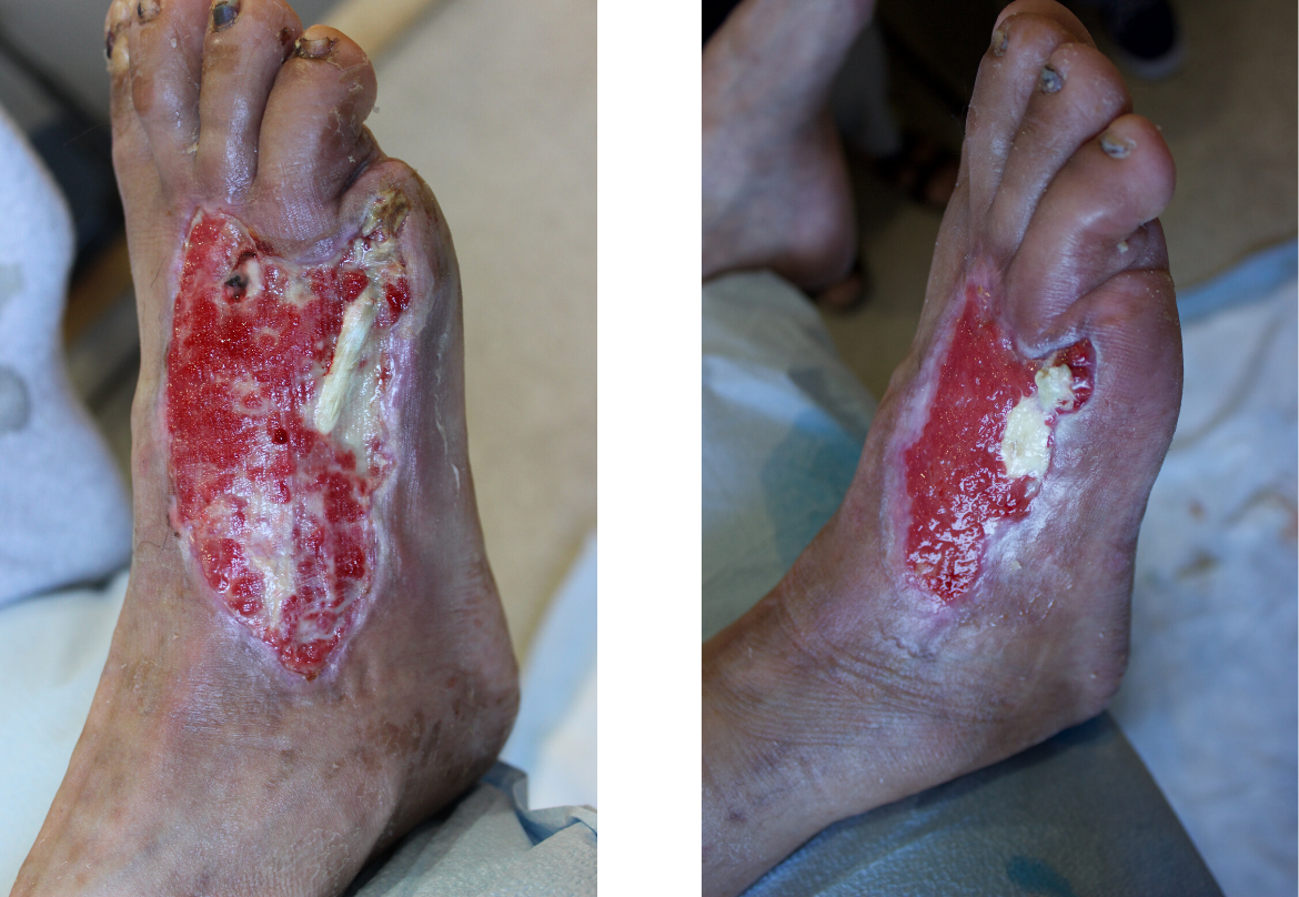 Skin Substitutes The Best Successful Skin Restoration