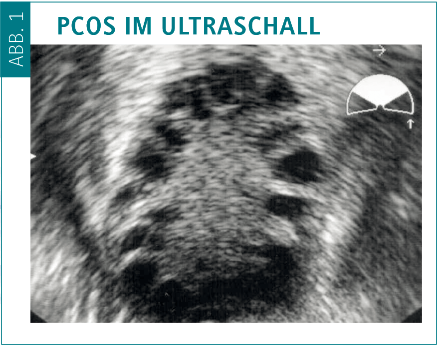 Evidenzbasiertes Management des polyzystischen Ovarsyndroms