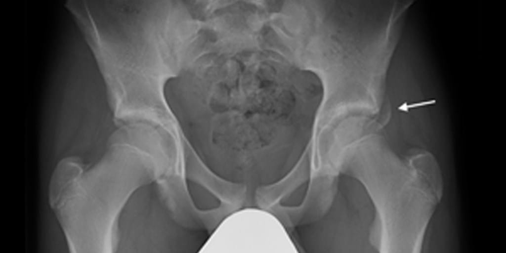 Hip Sprain. Or something else? Axis Sports Med