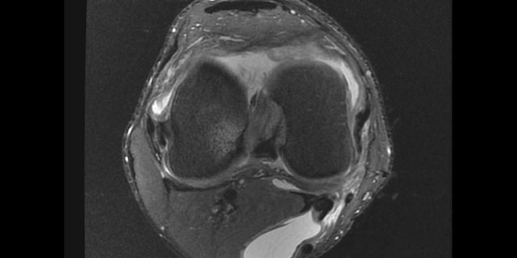 Radiology Review I've got a Bakers Cyst Axis Sports Med