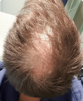 2 months of hair regrowth