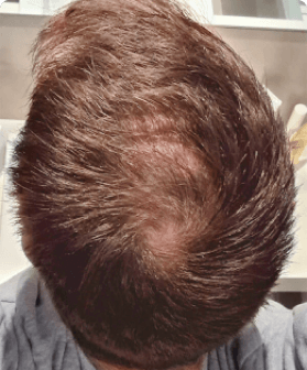 10 months of hair regrowth with Pilot