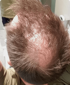 A Pilot customer before receiving hair treatment