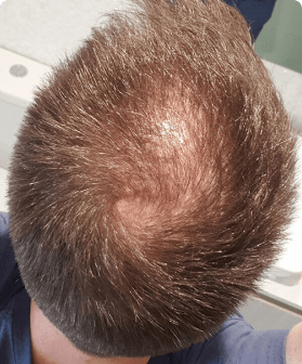 4 months of hair regrowth with Pilot