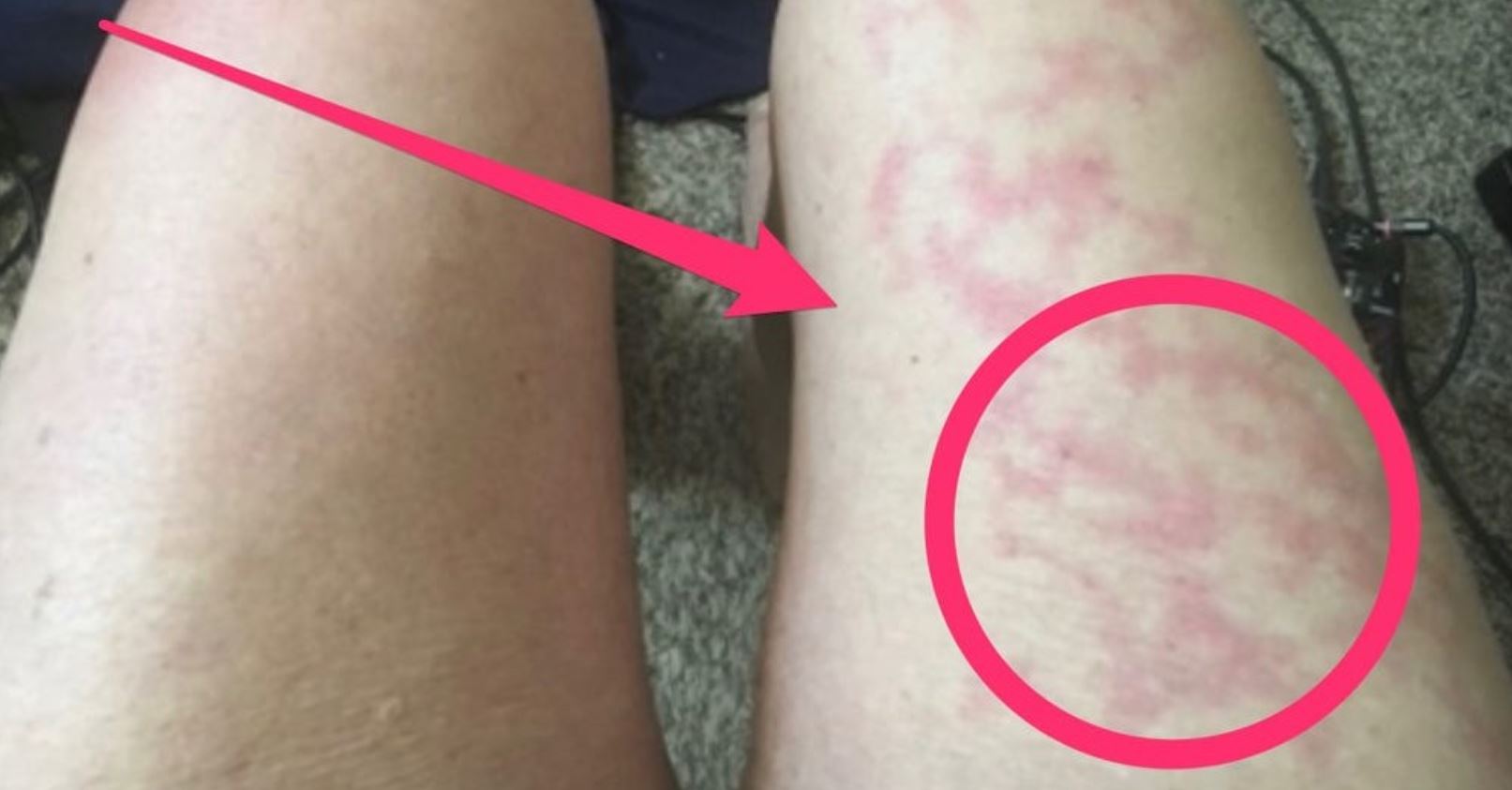 How to Get Rid of Hives after COVID19 McAllen Emergency Room