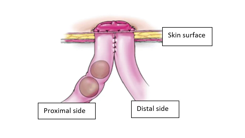 What Is a Stoma/Enterostomy?