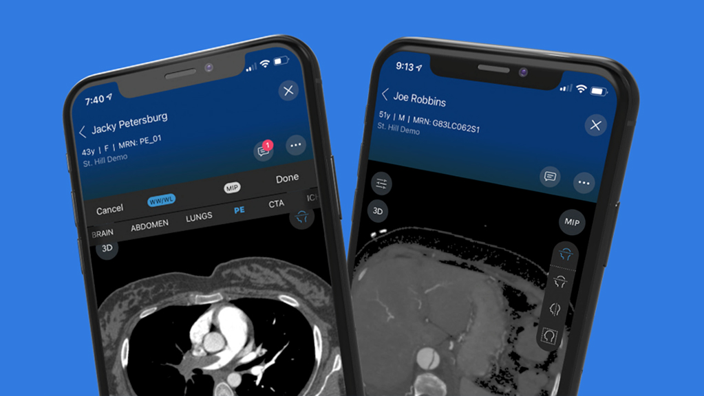 Viz.ai is the only artificial intelligence solution with modules for the detection of suspected pulmonary embolism and aortic disease.