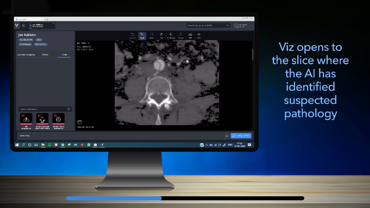 Watch our presentation video at the ASNR 2022 conference.