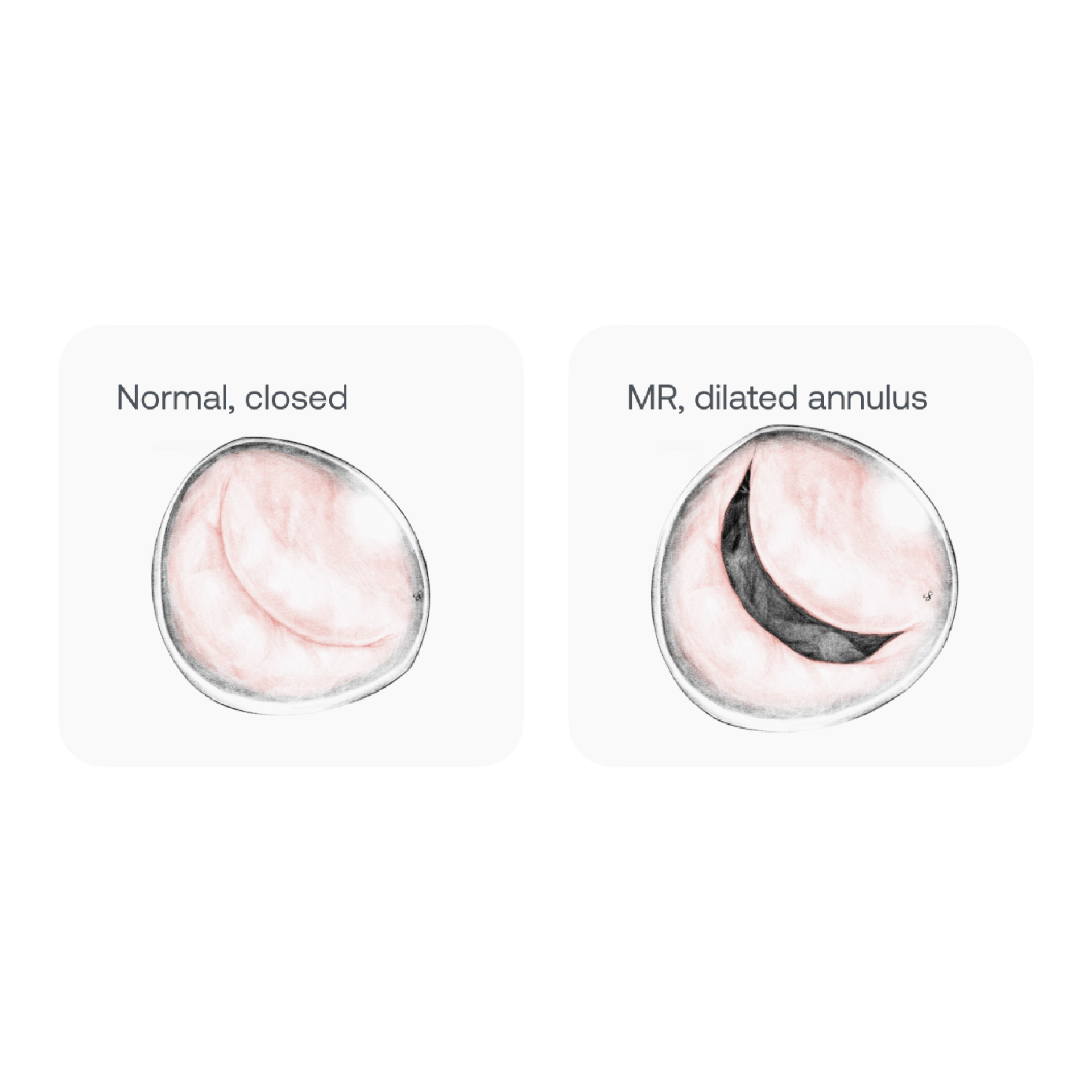 What is Mitral Regurgitation Eko