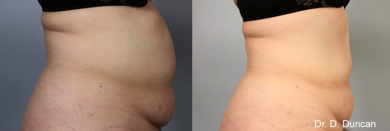 BodyFX Result
