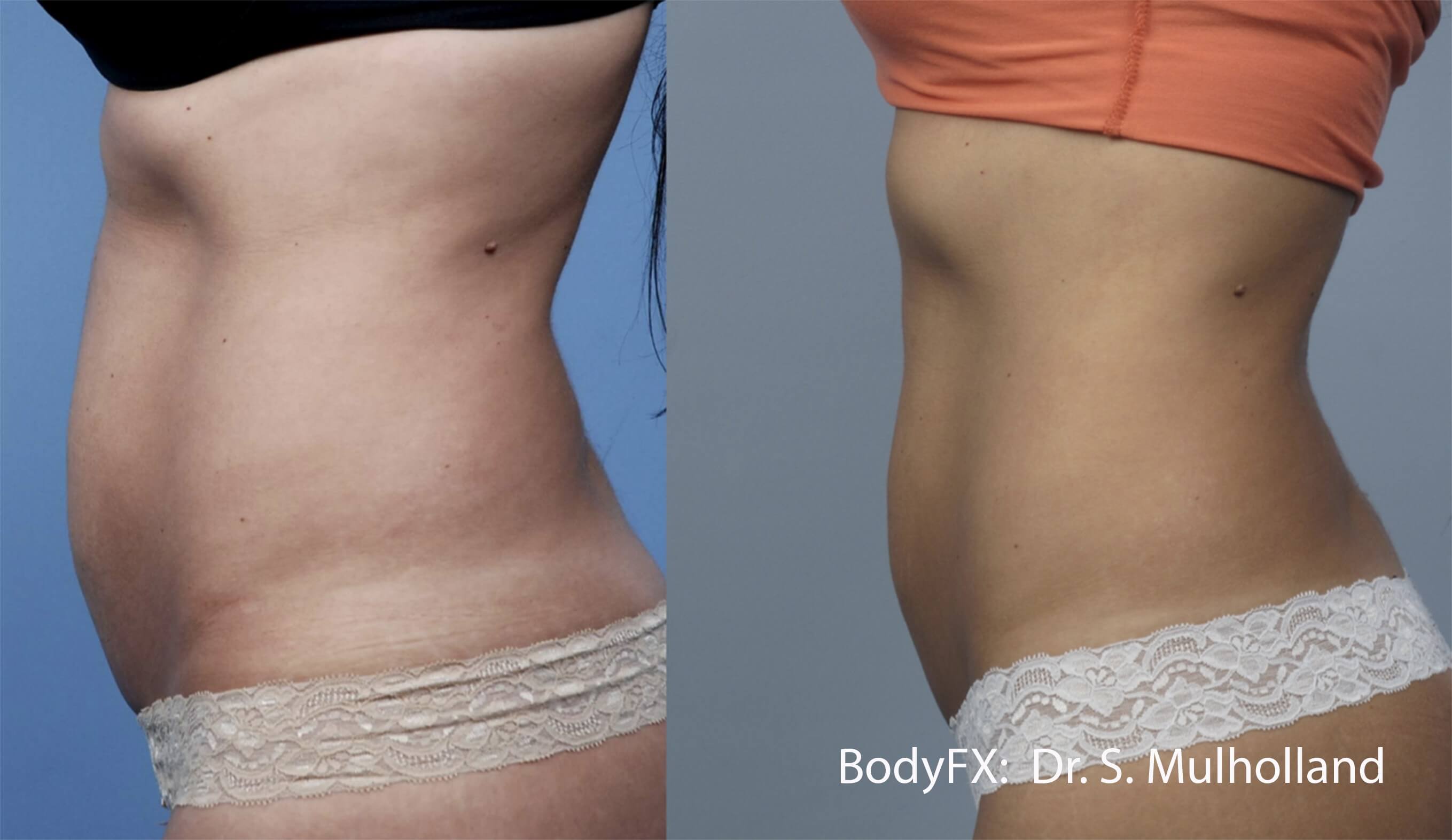 BodyFX Results 2 Image