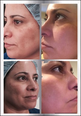 before-after-clear-brilliant