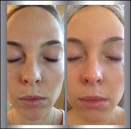 before-after-clear-brilliant