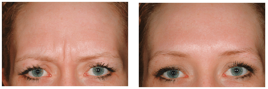 Dysport Before-After Client Image