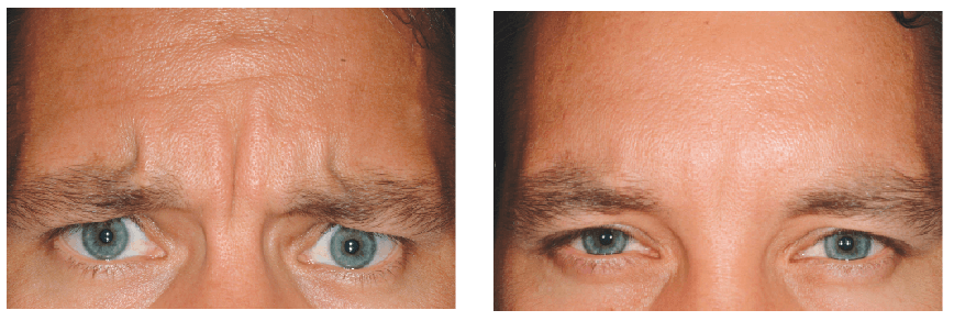 Dysport Before-After Client Image