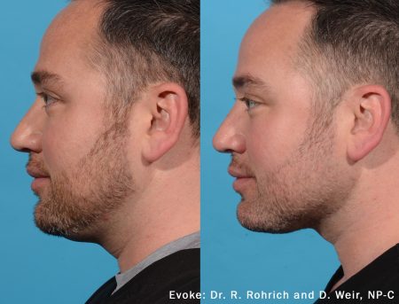 Evoke_male_NeckLeft