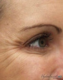 Hydrafacial female eyes before