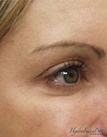 Hydrafacial female eyes after