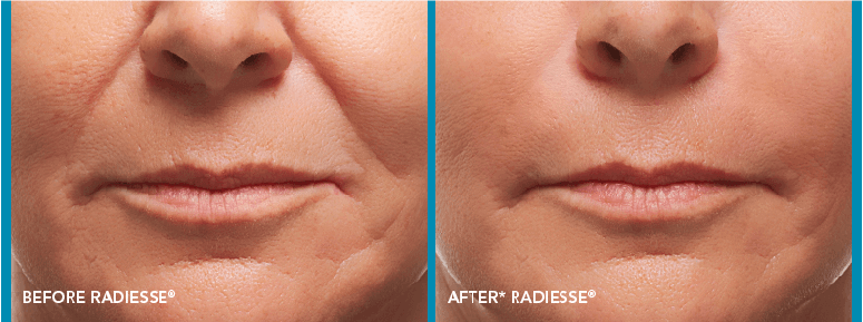 Radiesse Before-After Client Image