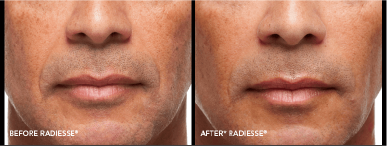 Radiesse Before-After Client Image