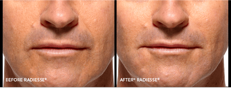 Radiesse Before-After Client Image