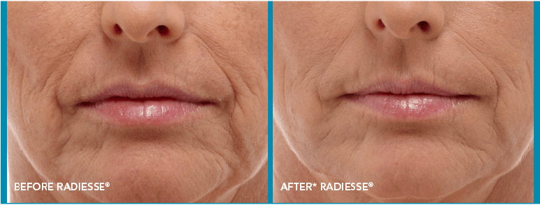 Radiesse Before-After Client Image
