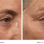 Non surgical face lift ultherapy