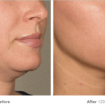 Ultherapy before and after images