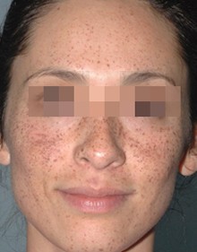 Lumecca Results Female Face B Before