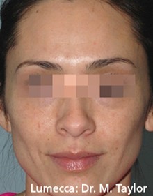 Lumecca Results Female Face B After