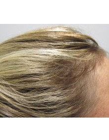 Viviscal Hair Growth After - Results