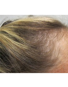 Viviscal Hair Growth Women Hair Before - Results